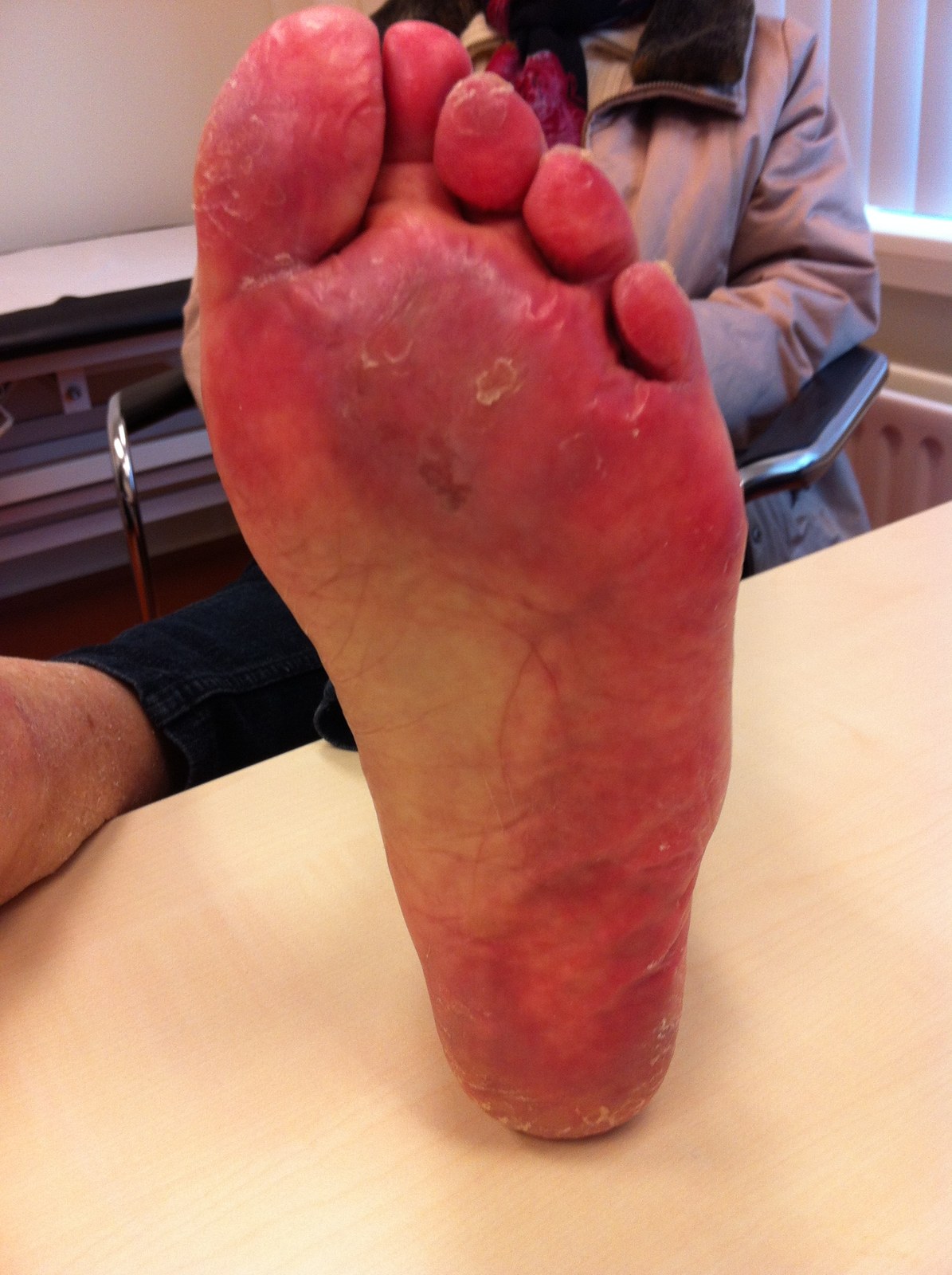 Hand-voetsyndroom graad 2