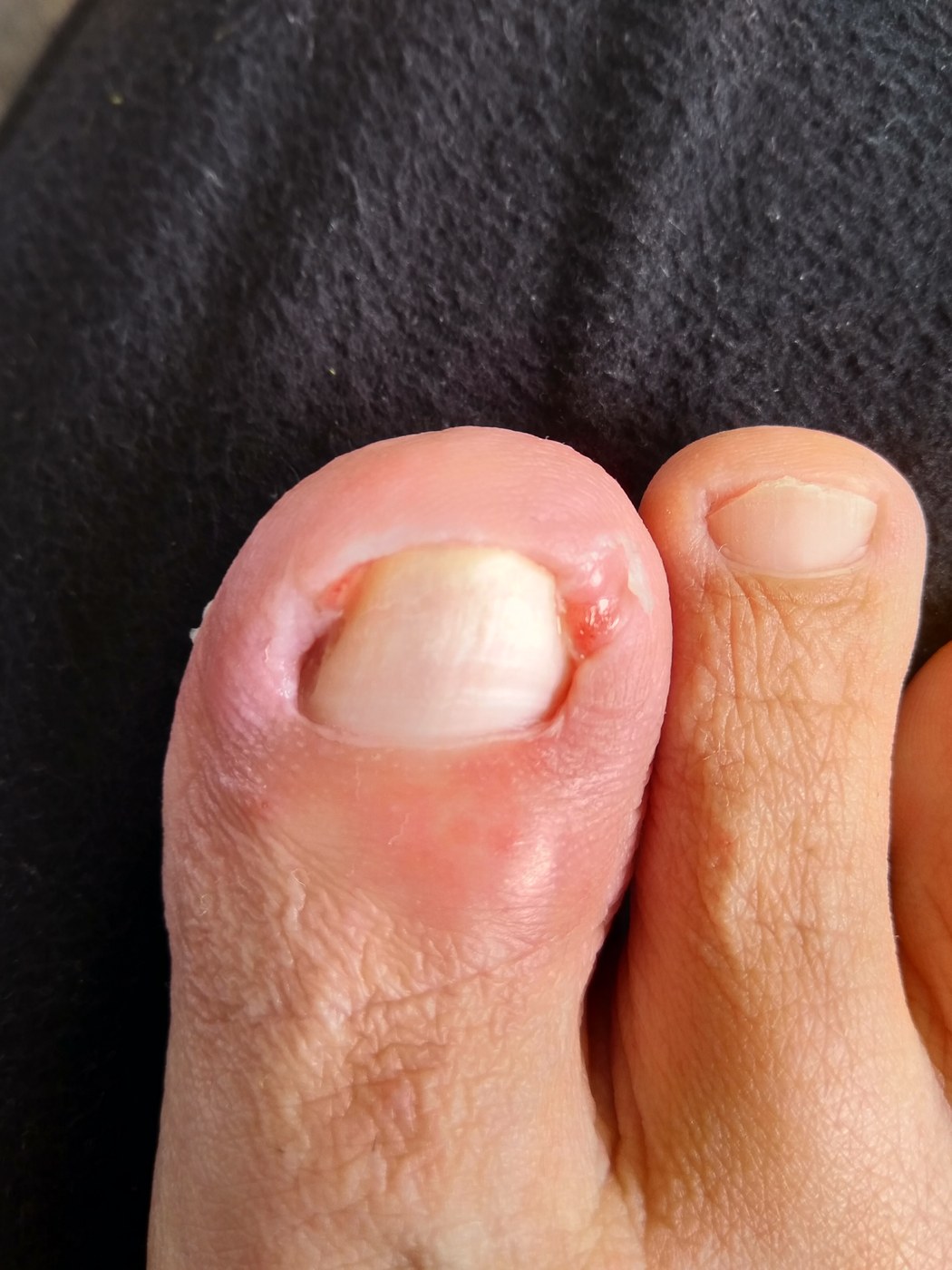 Paronychia bij oncologische behandeling